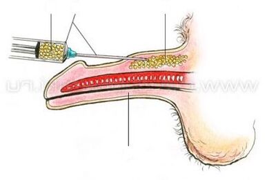 საინექციო პენისის გაფართოება